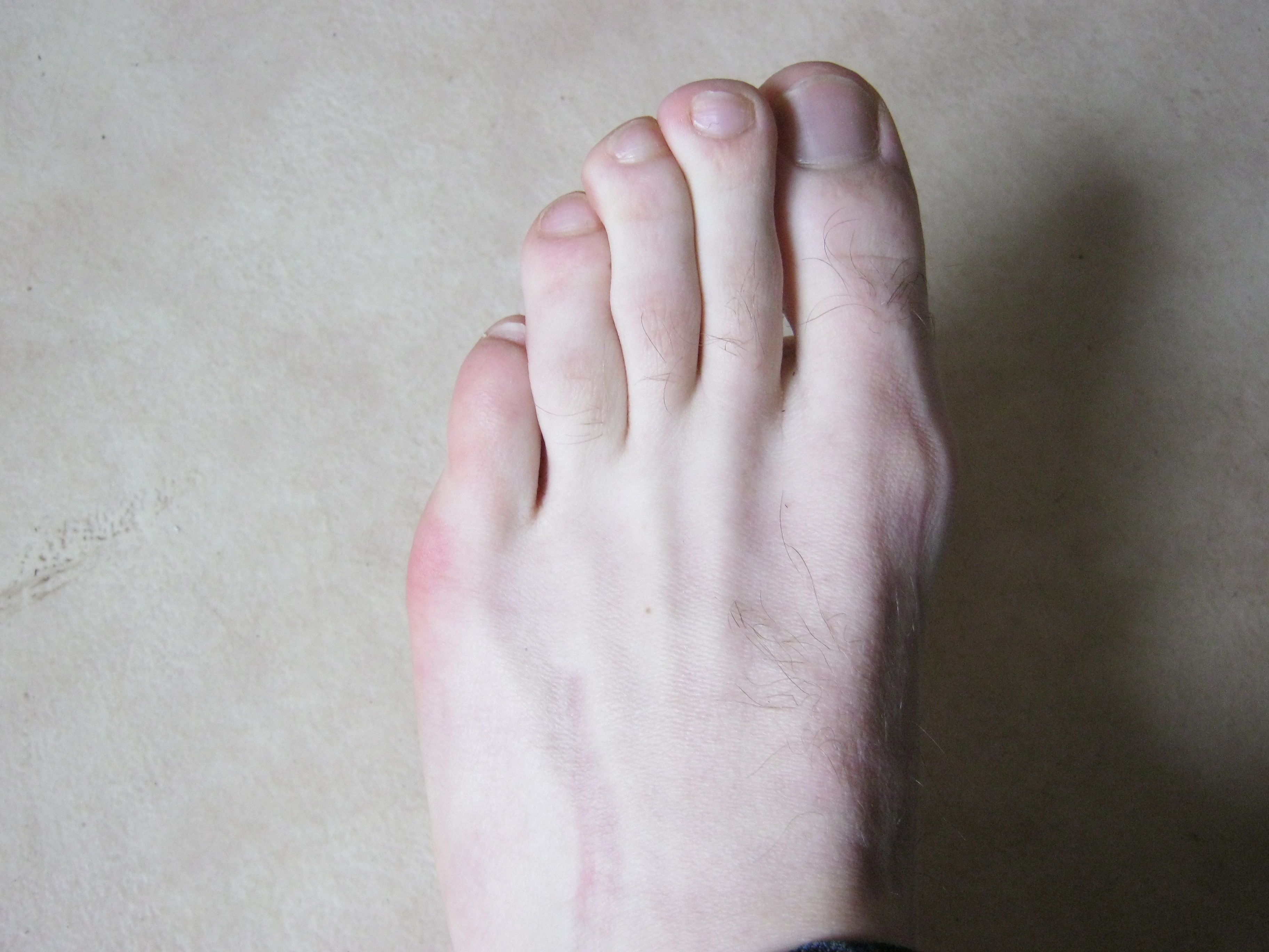 os de pied qui ressort os de pied qui ressort